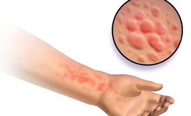 Manifestations of the schistosomosis in humans