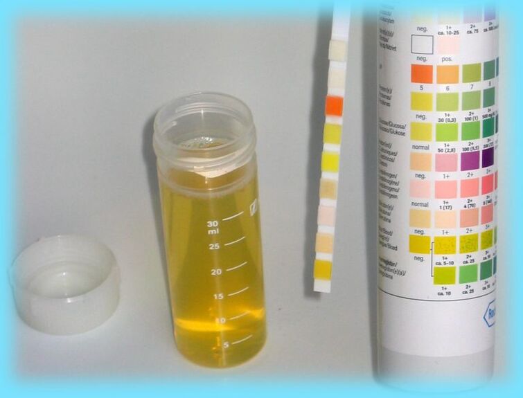 Urine analysis